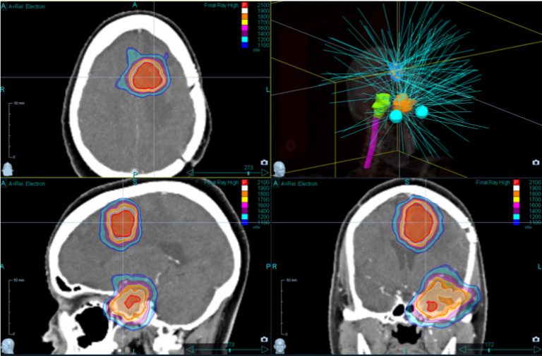 Brain Stereotactic Radiosurgery With CyberKnife Accuray