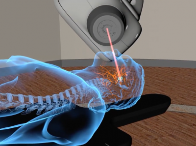 Brain Stereotactic Radiosurgery With CyberKnife Accuray