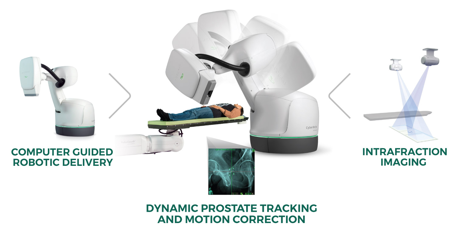 Prostate Sbrt With Cyberknife Precise Innovative Tumor Treatments Accuray