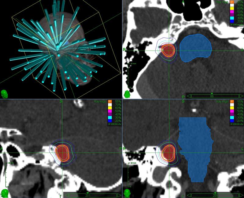 Brain SRS with CyberKnife - Precise, Innovative Tumor Treatments | Accuray