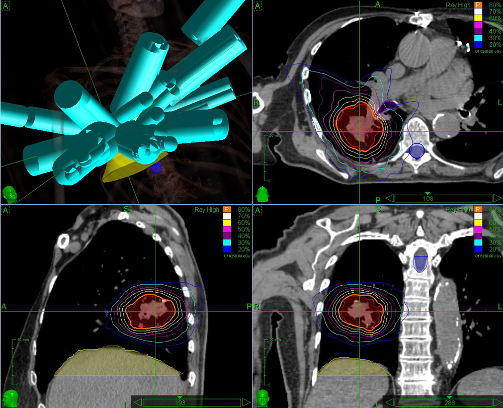 Lung SBRT with CyberKnife Accuray