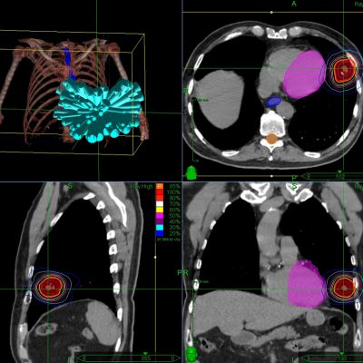 Lung SBRT with CyberKnife | Accuray