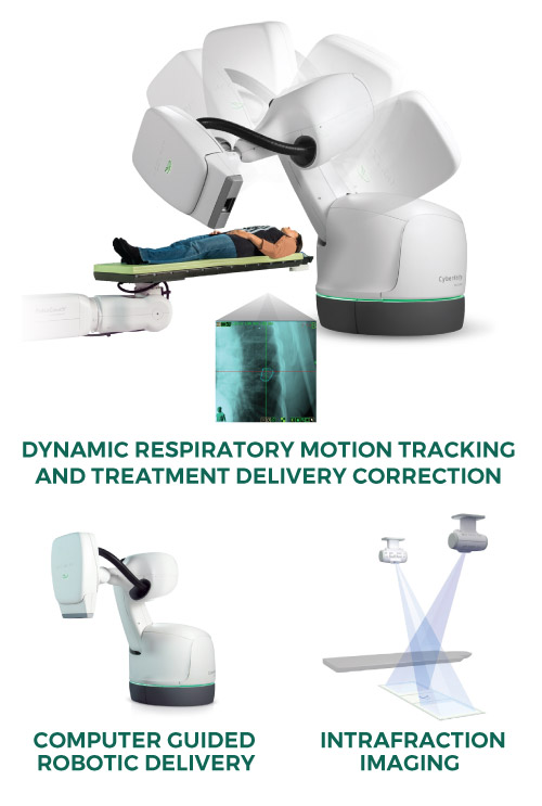 Lung SBRT with CyberKnife | Accuray