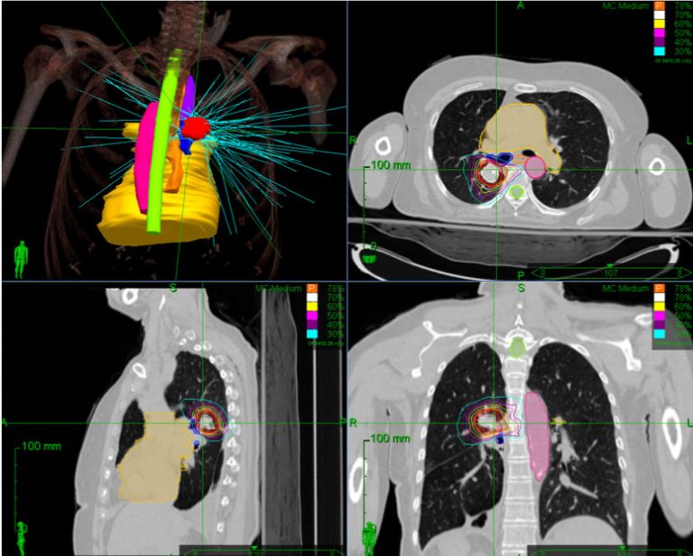 SBRT Lung with CyberKnife Accuray